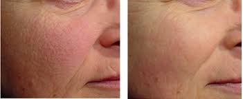 Before & After 3D Skin Rejuvenation