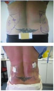 Before and After BodyTite Surgery