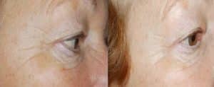 Eye peel for skin rejuvenation treatment
