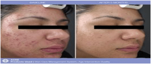 Before & After Glycolic Acid Peels