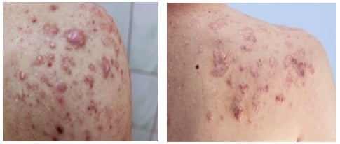 Keloid Acne Scarring Upper Back