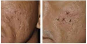 Laser Resurfacing