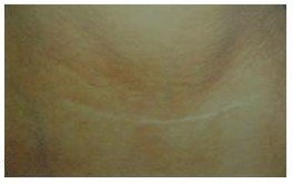 Post Inflammatory Hypopigmentation