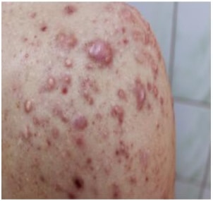 Keloid Scarring