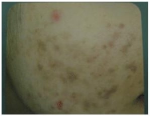 Post Inflammatory Pigmentation Acne Scarring