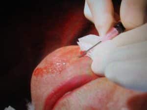 Subscision Treatment for Scarring