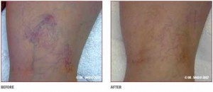 Before & After Thread Veins Laser Treatment