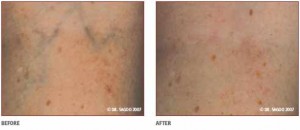 Results of Thread Vein Laser Removal