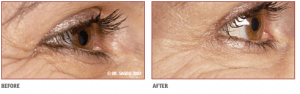 Before & After Muscle Relaxing Injections Around The Eyes