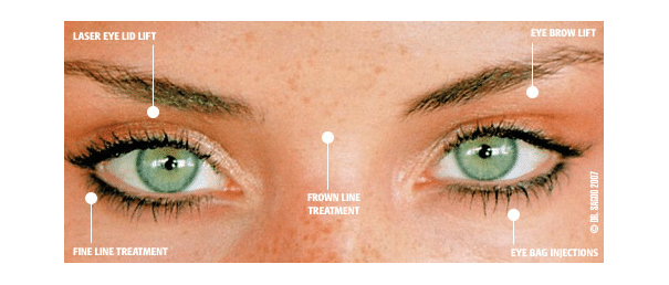 Non-Surgical Eye Skin Treatment