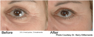 Before & After Results of Non Surgical Eye Treatment