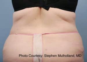 BodyTite Liposuction Treatment