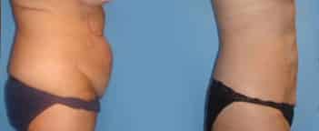 bodytite liposuction