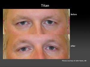 Titan Skin Tightening Treatment for Eyes