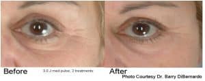 Before & After Non-Surgical Eye Treatment