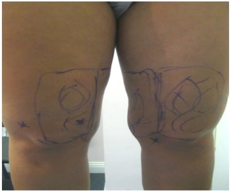 Before Liposuction Treatment