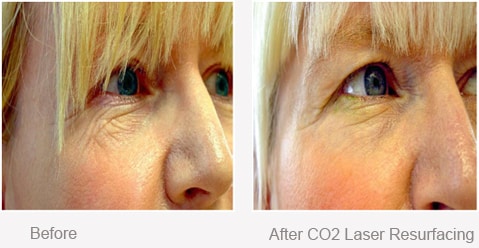 Before and After CO2 Laser