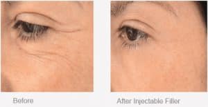 Non-Surgical Eye Treatment - Injectable Fillers