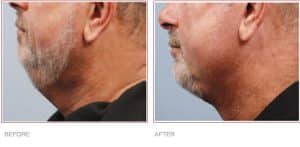 Before & After BodyTite Liposuction on Neck