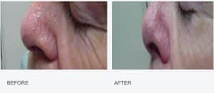Before & After Laser Treatment for Thread Veins on Nose