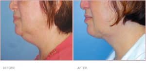 Before & After BodyTite Liposuction for Double Chin & Neck