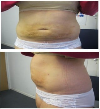 Before and After Liposuction Treatment