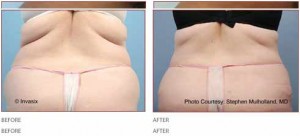 Before & After BodyTite Liposuction Treatment