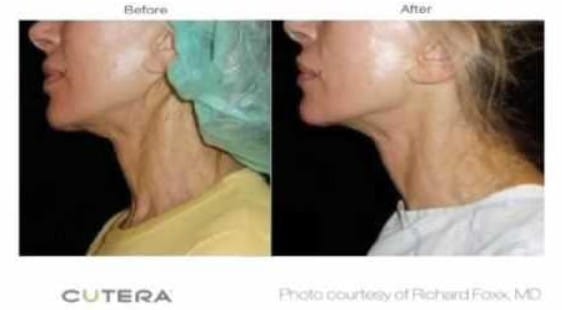 Before and After Fractora Treatment