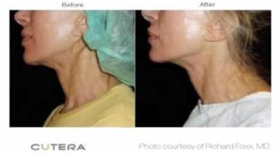 Before and After Fractora skin rejuvenation Treatment