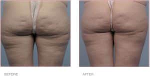 Before & After BodyTite Liposuction for Bum & Legs