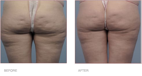 Before and After Cellulite Treatment