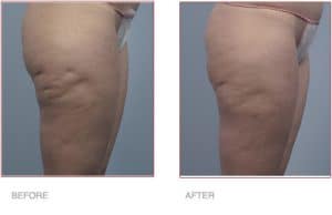 Before & After BodyTite Liposuction for Bum & Legs