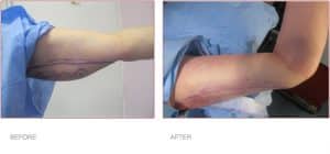 Before & After ArmTite Liposuction