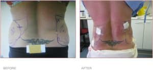 BodyTite Liposuction Before & After Treatment