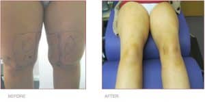 BodyTite Liposuction on Legs