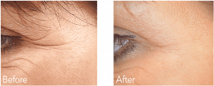 Before & After Fillers Treating Crows Feet