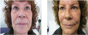Before & After Dermal Filler Treatment