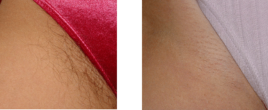 laser hair removal - before and after 3 days of treatment