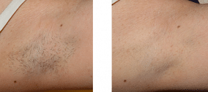 Before & After Arm Pit Hair Removal