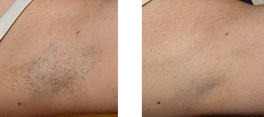 laser hair removal - before and after armpit