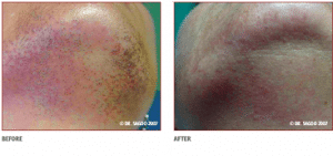 Before & After Laser Chin Hair Removal