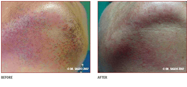laser hair removal - before and after chin treament