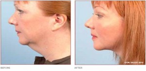 Before & After BodyTite Liposuction for Double Chin & Neck