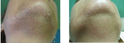 laser hair removal - before and after chin