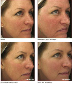 Results After 2 Pearl Laser Treatments