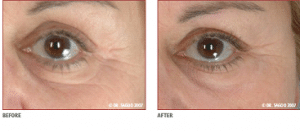 Pearl Laser Treatment for Around The Eyes