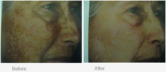 Before and After Treatment