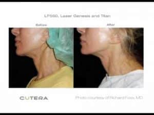 Before & After of the Laser Genesis Treatment