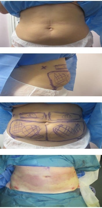 Before and After Liposuction Treatment