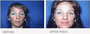 Before & After Chemical Peels for Acne